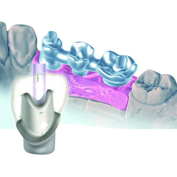 Tizian Creativ RT, Abutment Designer