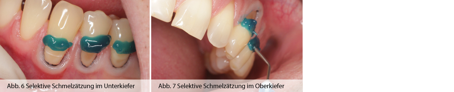 3_Selektive-Schmelz-tzung