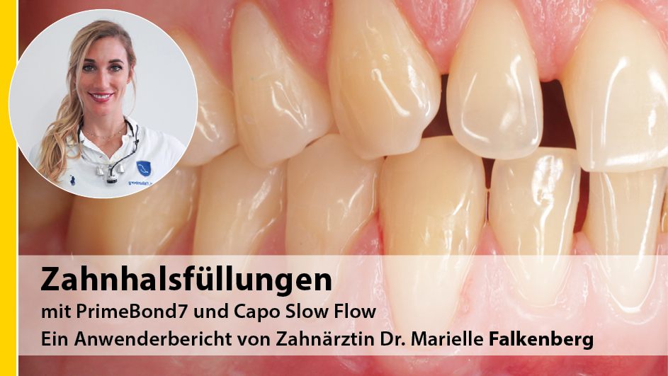2021-11_Newsseite_Anwenderbericht_Zahnhalsfuellungen