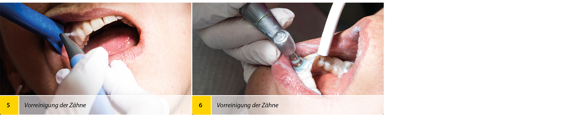 2020-04_Bleaching_Anwenderbericht_Heck_Bilder3