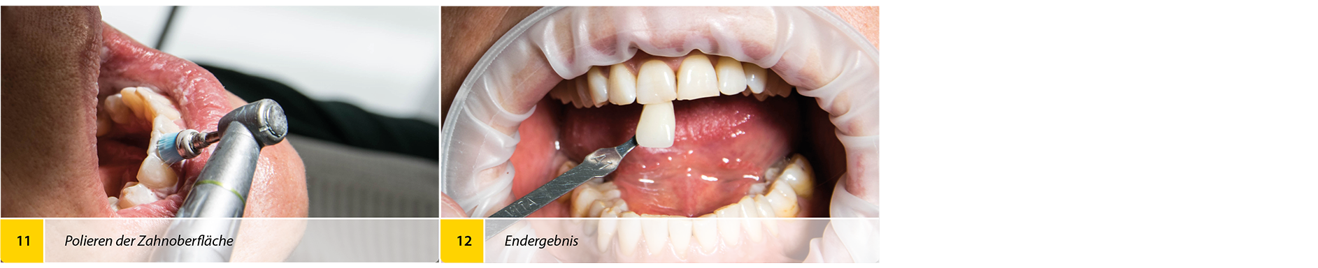 2020-04_Bleaching_Anwenderbericht_Heck_Bilder6