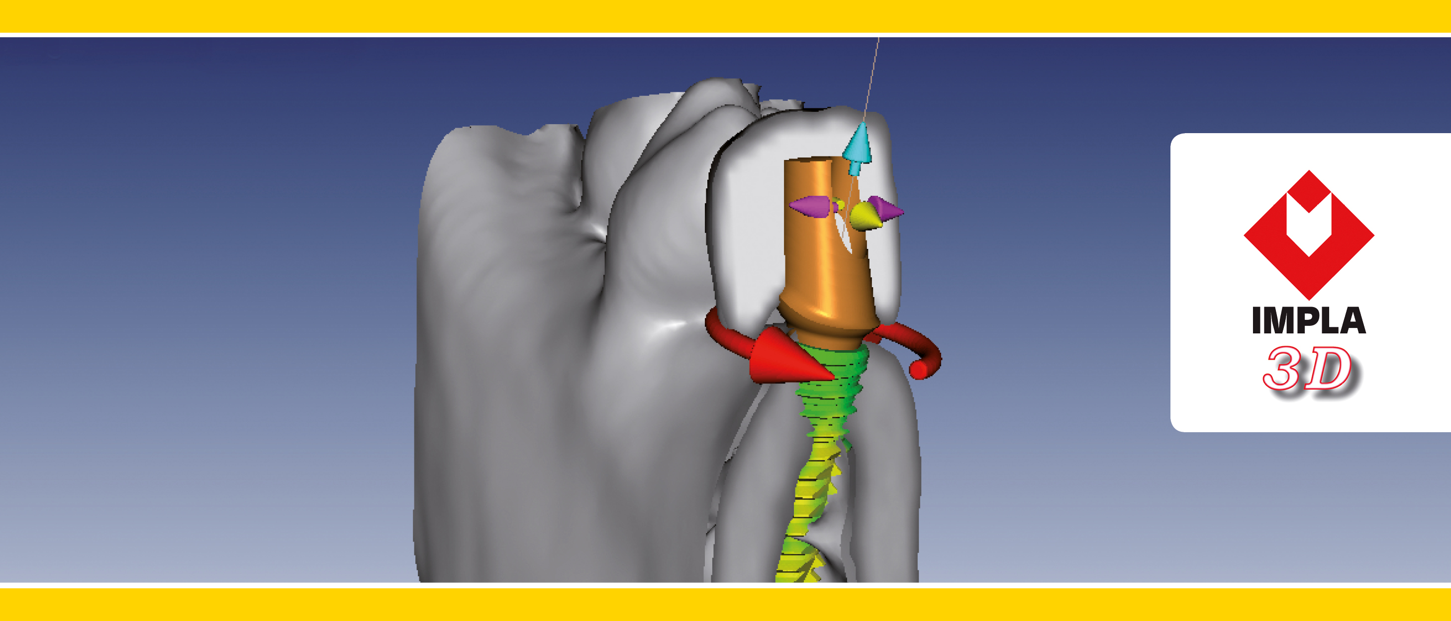 IMPLA 3D Implantatplanung im IMPLA 3D Implantatplanung im