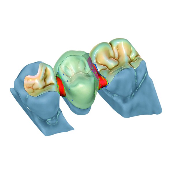 Tizian Creativ RT TruSmile module