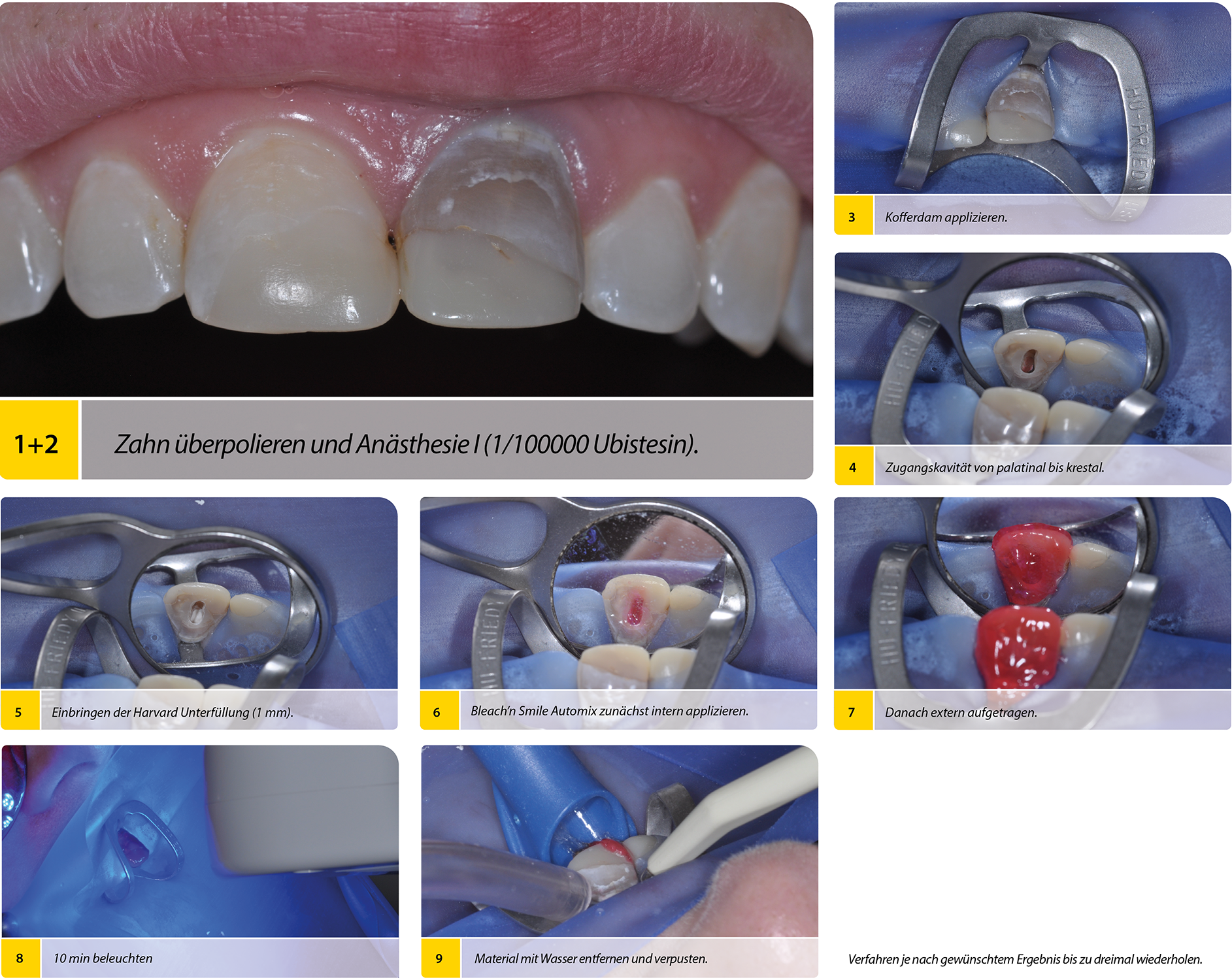 2020-03_Endo-Bleaching-Step-by-Step